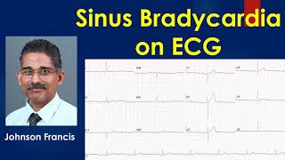 Sinus Bradycardia on ECG [upl. by Olympia887]