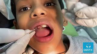 DrKiranKoora Pediatric Dentist  Operculectomy Procedure [upl. by Noiraa]