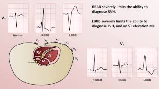 Intro to EKG Interpretation  Bundle Branch Blocks [upl. by Maison]