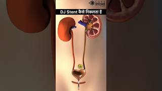 DJ Stent Removal  Retrograde Intrarenal Surgery  kidney stone treatment shorts [upl. by Foote570]