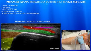 Ultrasound Guided Cortisone Injection for Presumed Gouty Prepatellar Bursitis in a 66 Year Old Male [upl. by Dunning]