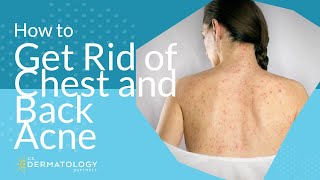 How to Get Rid of Chest and Back Acne [upl. by Renard]