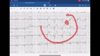 Sgarbossa Criteria Example Paced Rhythm [upl. by Nonaihr]