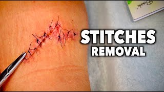 REMOVING 13 STITCHES From a Huge Leg Wound  Dr Paul [upl. by Notpmah190]