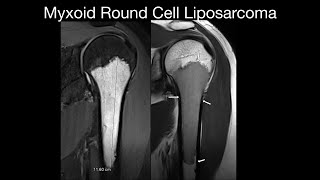 Myxoid Round Cell Liposarcoma [upl. by Zoha976]