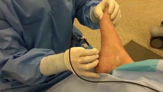 Radiofrequency Nerve Ablation for Heel Pain [upl. by Rambert850]