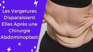 Les Vergetures Disparaissent Elles Après une Chirurgie Abdominoplastie [upl. by Eylatan]