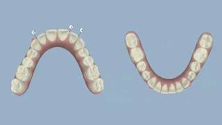 Invisalign  Midline Shift and IPR  Dr Thomas Gibbs DDS [upl. by Rafi]