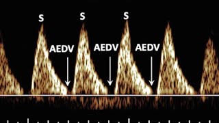 Severe Fetoplacental insufficiencyAbsent diastolic flow on umbilical artery Doppler [upl. by Hgielrahc]