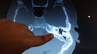 HRCT Temporal Bone Anatomy as per Reporting format By Gaurav Rawat [upl. by Harbert]