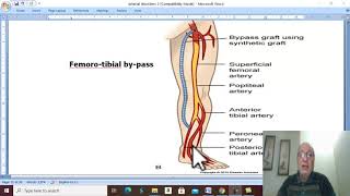 Arterial Disorders in Arabic 28  Buergers Disease  part 2   by Dr Wahdan [upl. by Jamison]