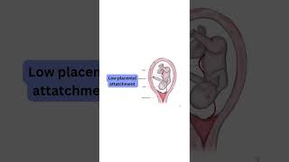 Low Lying Placenta in Pregnancy  Normal Delivery With Placenta ka Nichy hona Nuksan ya Faida [upl. by Yran]