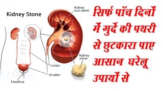 गुर्दे की पथरी का जड़ से इलाज  Health Tips In Hindi  Gharelu Nuskhe  Pathri Ka Ilaj [upl. by Pasadis]