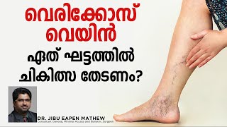 Vericose Vein  Talk by Dr Jibu Eapen Mathew  Caritas Hospital Kottayam [upl. by Redan256]