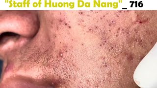 Staff of Huong Da Nang Very severe acne in a preteen patient Extracts blackheads716 [upl. by Alisha643]