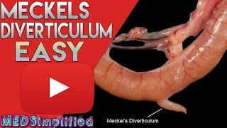 Meckels Diverticulum Made Easy [upl. by Eillen]