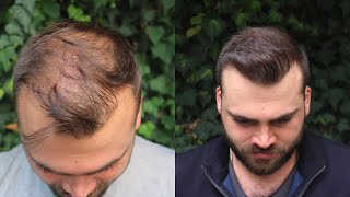 Hair Transplant Result with 3040 Grafts  EXTREME TRANSFORMATION from 0 days to 10 Months [upl. by Ybanrab]