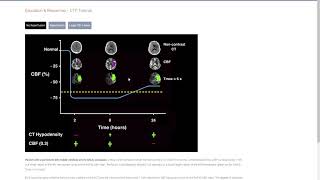 Starting CT perfusion service using ischemaviewRapid software for a community stroke center [upl. by Clayberg544]