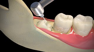 Wisdom Teeth Extraction  Step by step [upl. by Deloris]