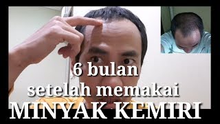 Pemakaian minyak kemiri setelah 6bulan hasilnya sangat [upl. by Theresina]