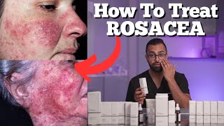 How to Effectively Treat Rosacea  How To Use The Ordinary Skincare for Rosacea [upl. by Furgeson]