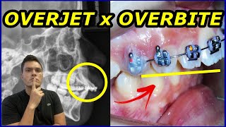 OVERJET x OVERBITE  QUAL A DIFERENÇA  COMO O DENTISTA CORRIGE COM APARELHO [upl. by Kain]