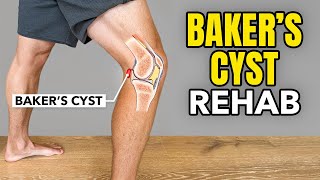 Bakers Cyst Treatment Rehab Exercises [upl. by Merrile]