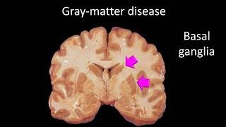 Neurometabolic disorders 2024 [upl. by Ellehsad]