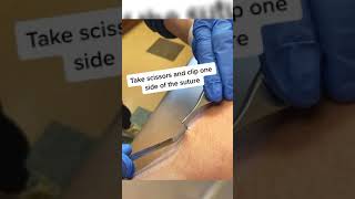 Suture Removal Instructional Video [upl. by Ivan626]