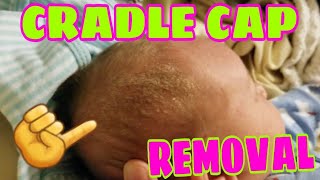 SUPER EASY AND NATURAL WAY TO REMOVE CRADLE CAP [upl. by Pizor22]