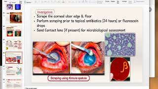 Bacterial Keratitis Part 2 [upl. by Woodring703]