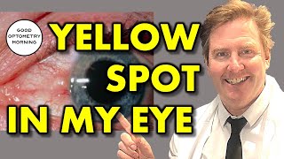 YELLOW SPOT IN EYE Pinguecula treatment from Youtube Eye Doctor amp Optometrist [upl. by Cherry286]