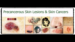 short note about  Precancerous Skin Lesions and Skin Cancer [upl. by Atiluj980]