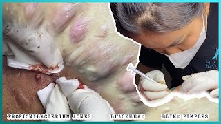 Big Cystic Acne Blackheads Extraction Blackheads amp Milia Whiteheads Removal Pimple Popping [upl. by Stratton]