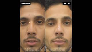 Non Surgical Rhinoplasty at CARA Clinic Mumbai  Instant NoseJob [upl. by Asor602]