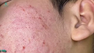 Big Cystic Acne Blackheads Extraction Blackheads amp Milia Whiteheads Removal Pimple Popping 006 [upl. by Anaihr]