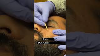 Scar Rejuvenation scar Treatment  TCA Cross  Co2 Laser Treatment before amp after shorts viral [upl. by Nye]