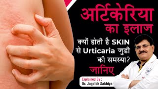 Urticaria Hives Causes Symptoms amp Treatment  In Hindi   Dr Jagdish Sakhiya Skin Clinic [upl. by Nayab89]