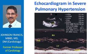 Echocardiogram in Severe Pulmonary Hypertension [upl. by Shelah]