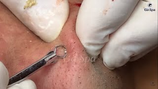 Full Blackhead Popping Video  HOT 2019  Part 3  END [upl. by Goulet]