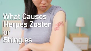 What Causes Shingles Zona [upl. by Martita]