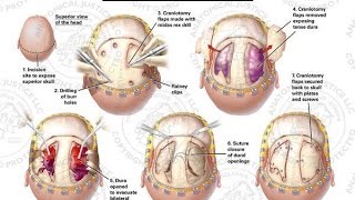 History of Brain Surgery  Neurosurgery [upl. by Kironde143]