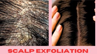 ONE THING SABOTAGING YOUR HAIR GROWTH Scalp Exfoliate for healthy scalp [upl. by Benisch694]