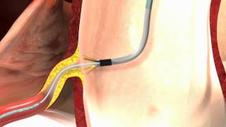 Ostial PRO® Stent Positioning System 3D Animated Video [upl. by Nittirb]