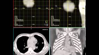 Moving lung tumor during imaging radiation therapy [upl. by Saied]