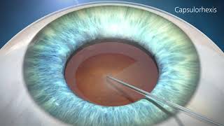 Cataract Surgery Animation [upl. by Anilehcim]