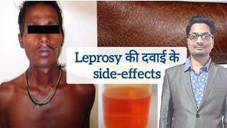 Leprosy की दवाइयों के sideeffects  Dapsone  Clofazimine  Rifampicin  Hansens disease leprosy [upl. by Zurciram]