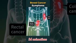 bowelcolorectal cancer symptoms shorts rectal bowel cancer [upl. by Illac383]