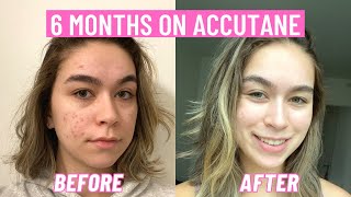 My six month Accutane journey and how I cleared my skin [upl. by Eihctir]