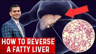 How To Reverse A Fatty Liver  Fatty Liver  How To Fix It [upl. by Tterrej95]